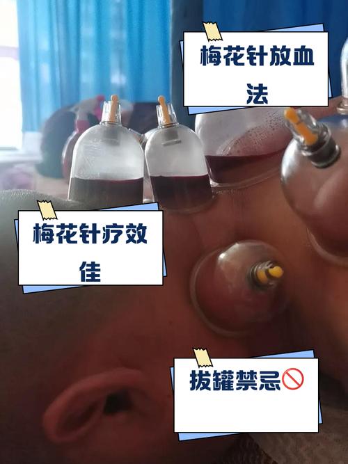 来例假可以针灸拔罐吗