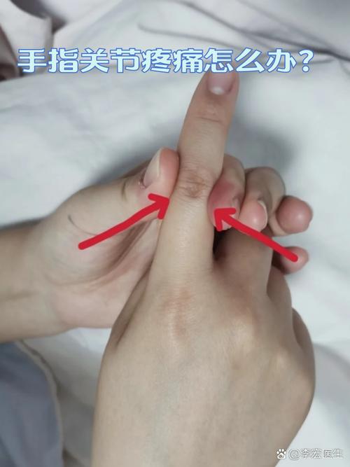 手痛风怎么办快速止痛