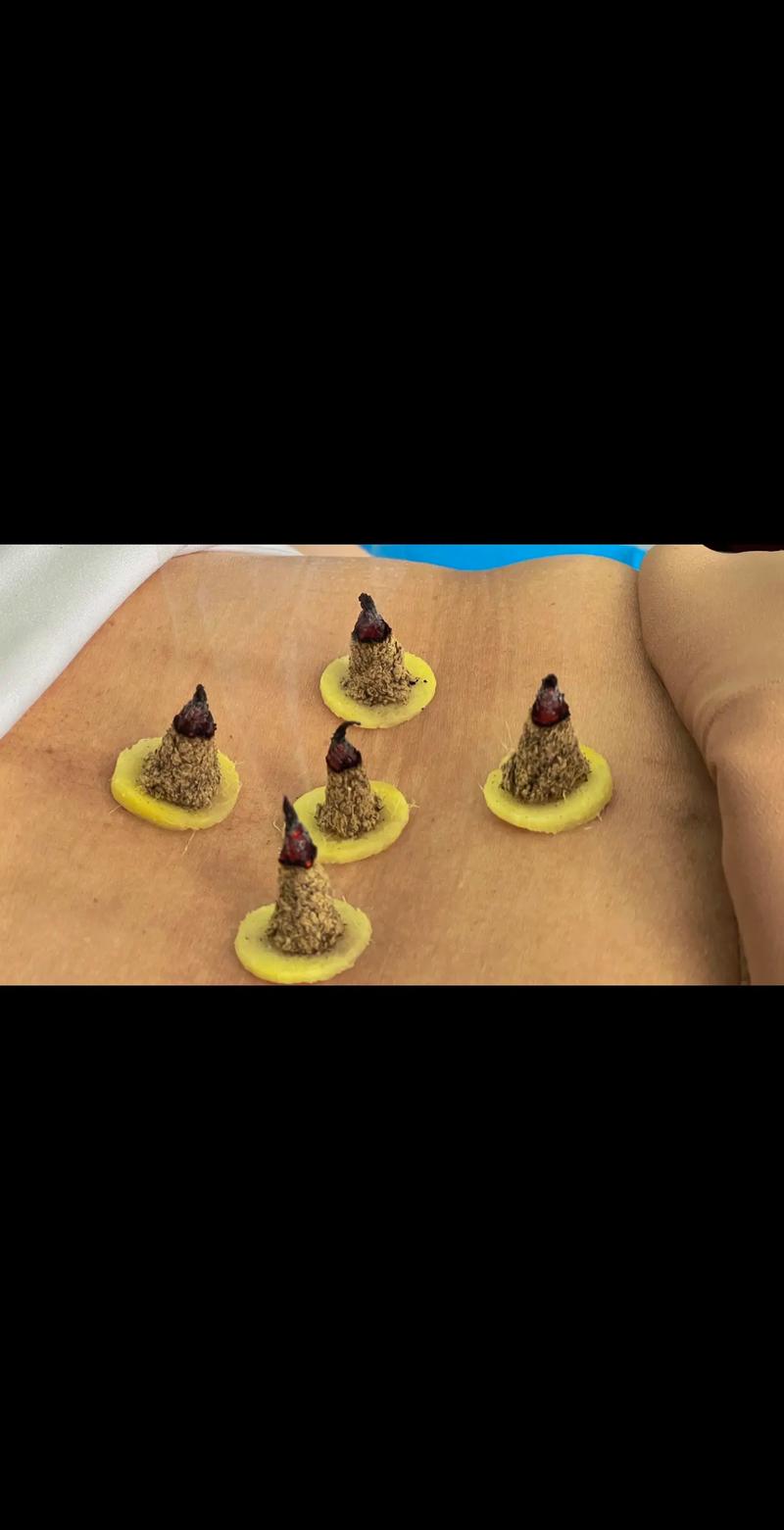 带状疱疹针灸治疗方法