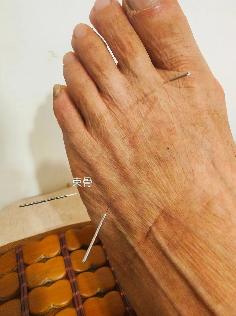 坐骨神经痛的针灸治疗