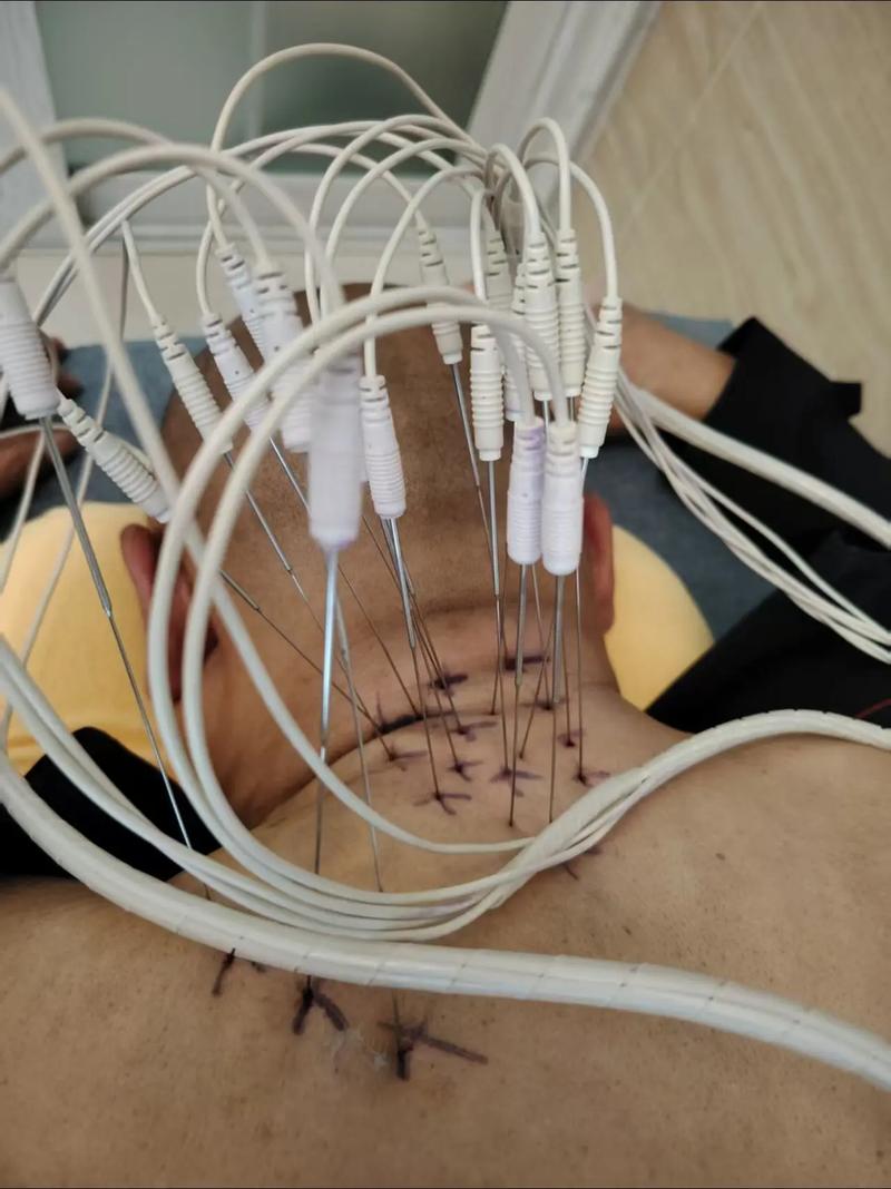 针灸治疗颈椎病的原理