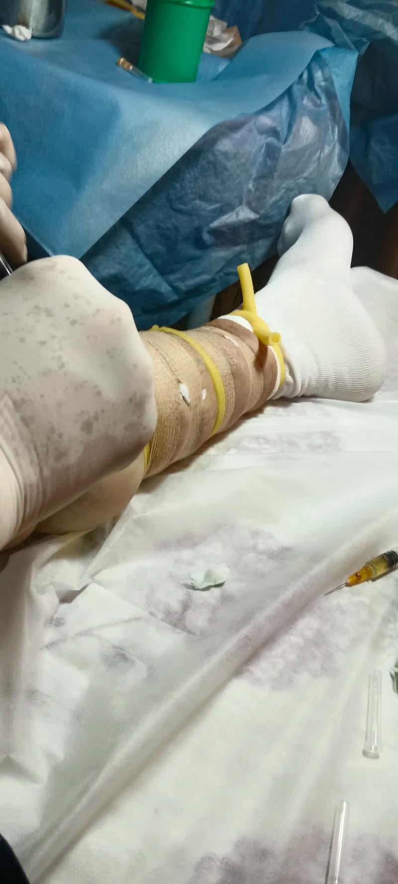 针灸能治疗静脉曲张吗