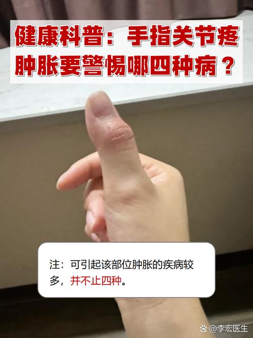 手指关节肿痛是痛风吗