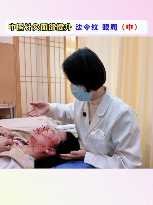 面部针灸能提升面部吗