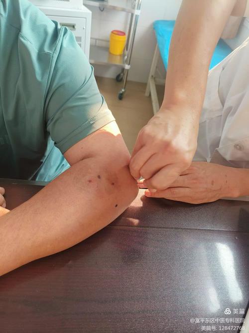 网球肘可以针灸治疗吗