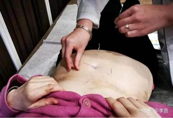 腰间盘突出针灸管用吗