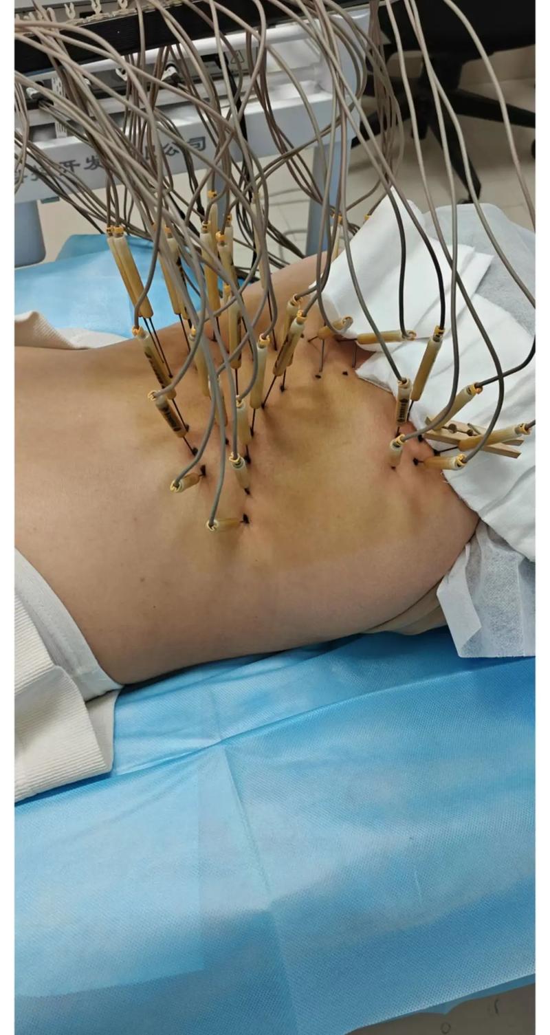 腰椎间盘突出针灸视频