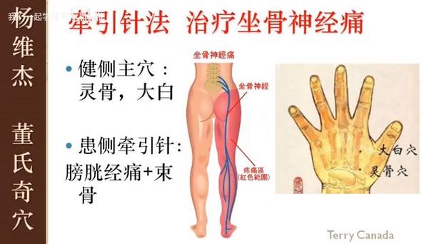 坐骨神经痛可以针灸吗