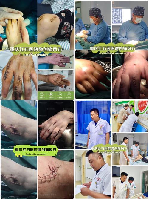 痛风石手术费用在多少