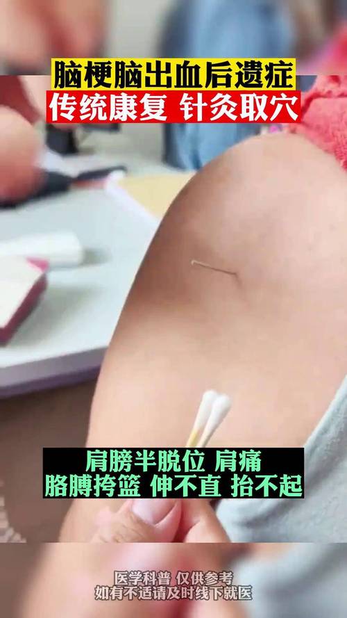 针灸治疗脑出血后遗症