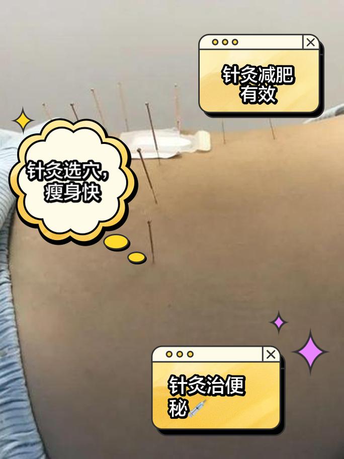 针灸减肥针灸哪些部位