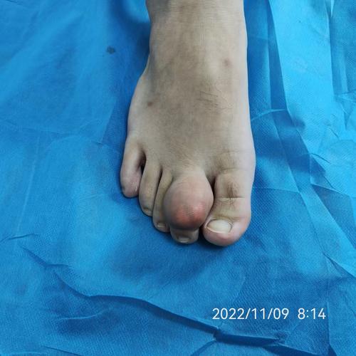 痛风石切除术手术记录