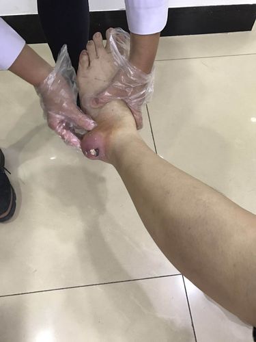 痛风石切除术手术记录