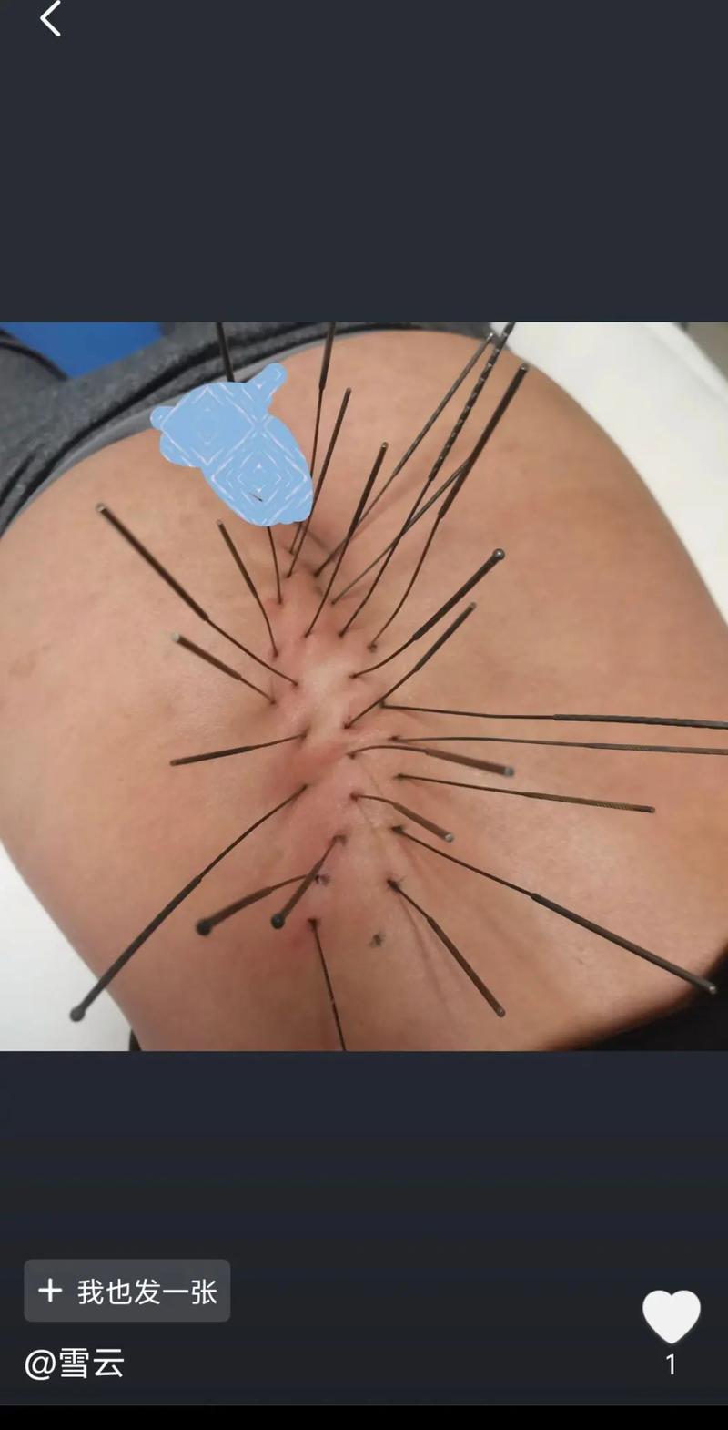 针灸治疗腰椎间盘突出