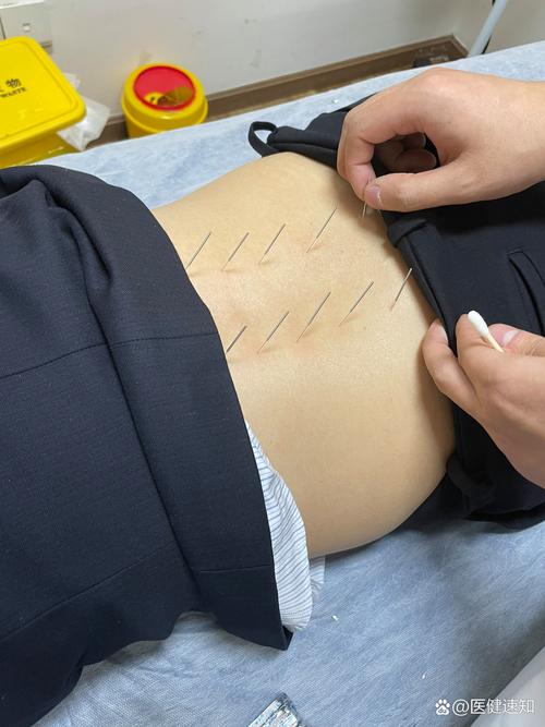 腰椎间盘突出针灸治疗