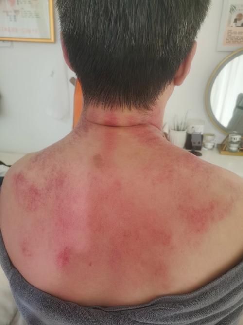 针灸扎出黑血是怎么了