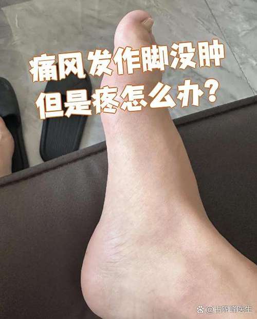 痛风不痛了但是没消肿