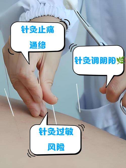 针灸做多了有副作用吗