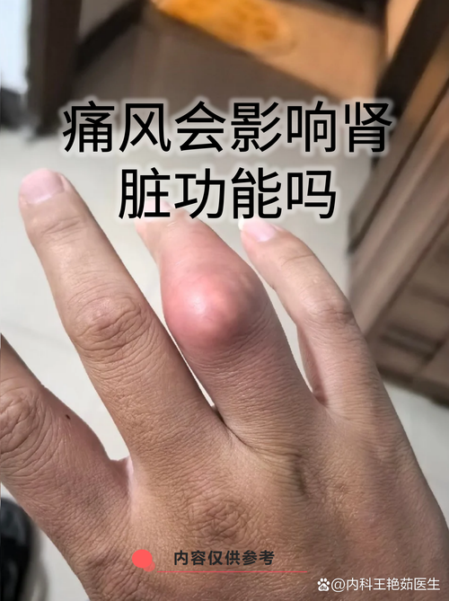 痛风对性生活有影响吗