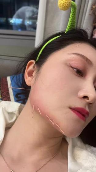 下颌关节紊乱针灸6次