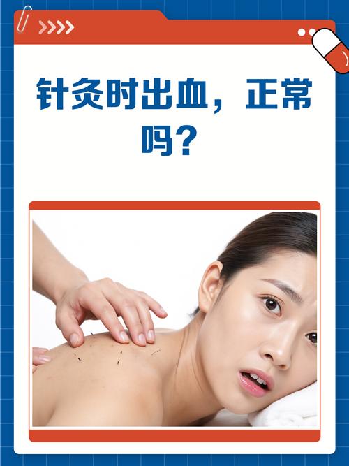 针灸会影响月经推迟吗