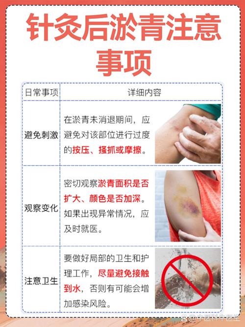 针灸后针眼一般疼几天