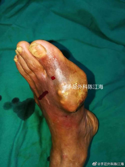 痛风手足泡浴剂在哪买