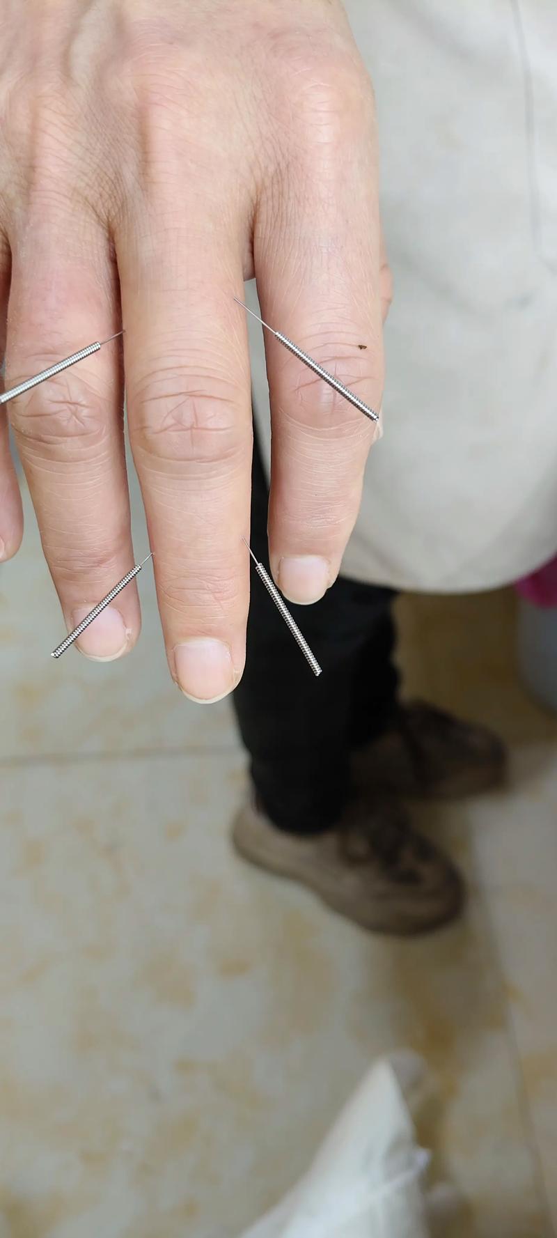 温针灸的操作方法视频