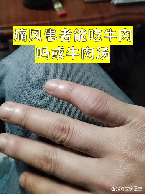 痛风病人可以吃牛肉吗