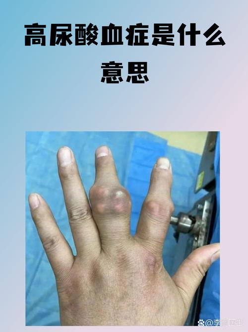 痛风肾上海明珠真不错