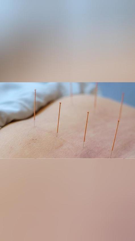 针灸图片高清图片大全