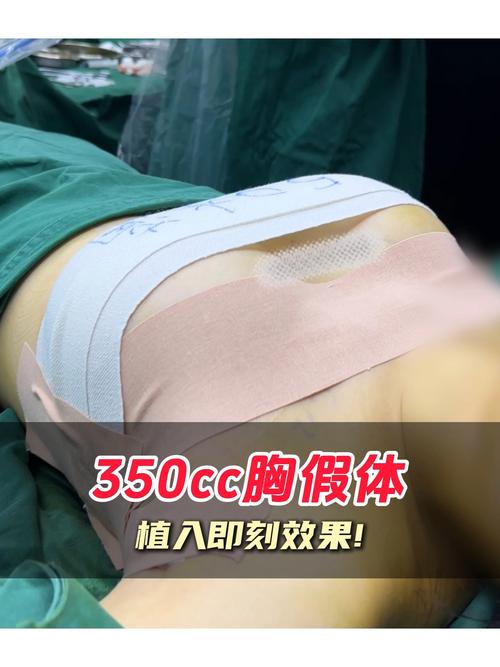 假体丰胸安全性怎么样