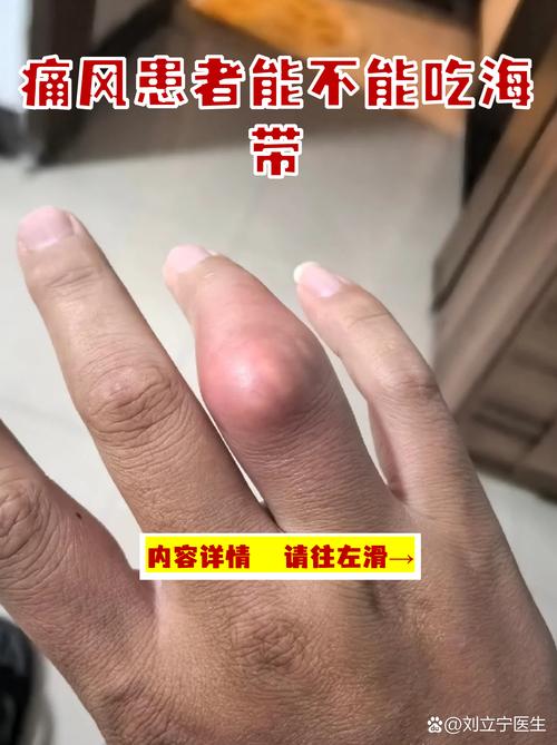 痛风患者能不能吃海带