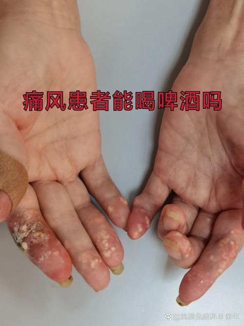 得了痛风可以喝什么酒