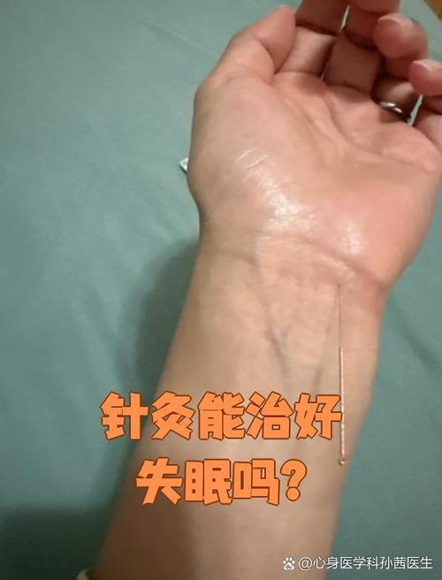 针灸失眠多久见效果