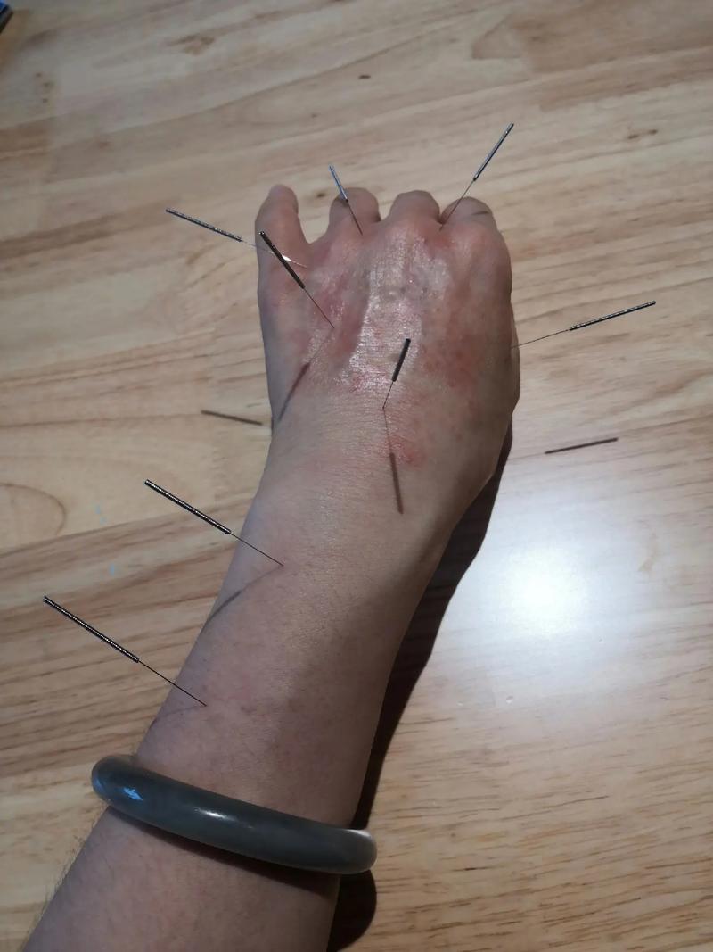 手背针灸有什么作用