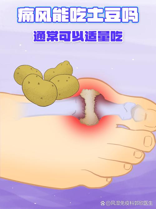 痛风患者可以吃土豆吗