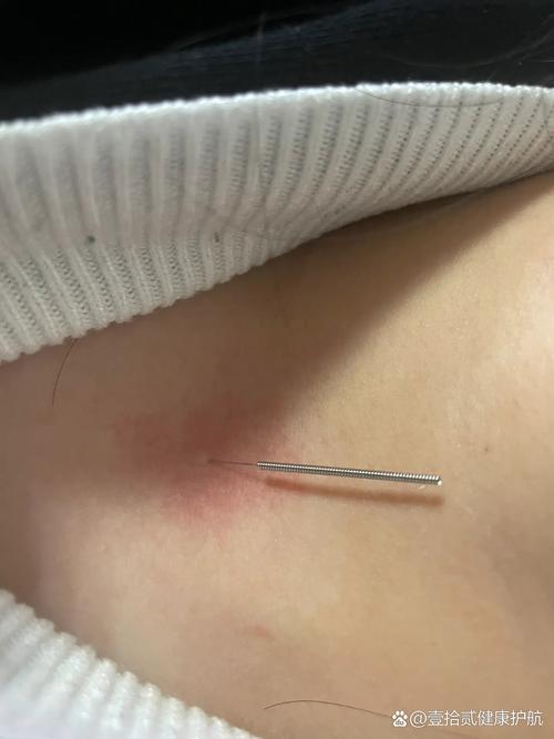 咽炎充血用针灸行吗