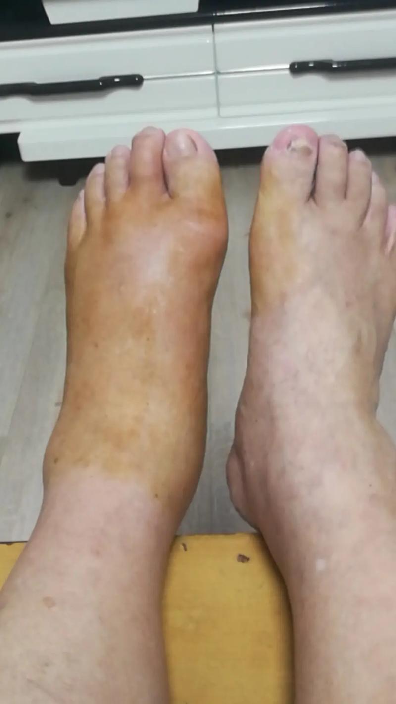 痛风出白色液体是什么