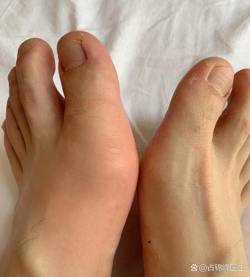 无缘无故脚背痛 痛风