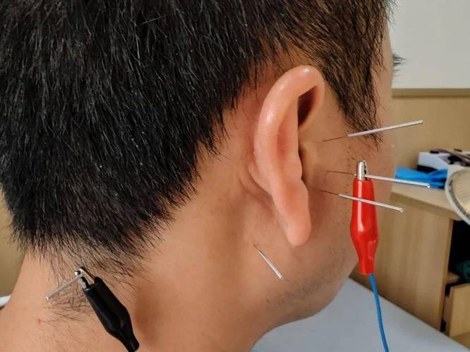 耳鸣能用针灸治疗时