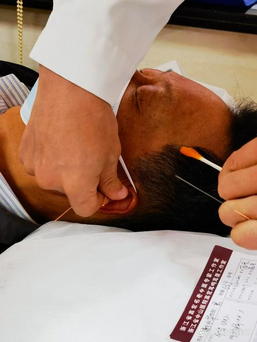 耳鸣能用针灸治疗时