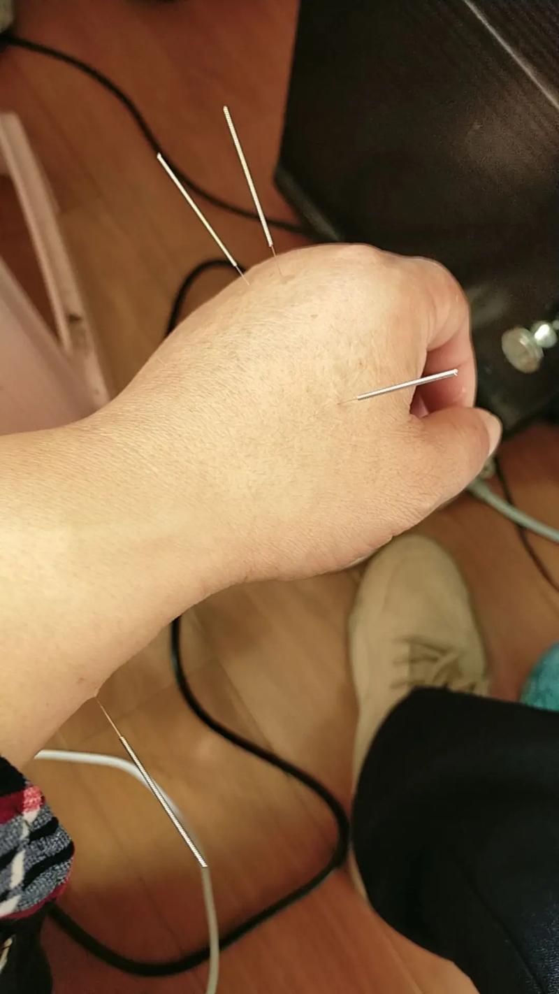 胳膊关节疼针灸行吗