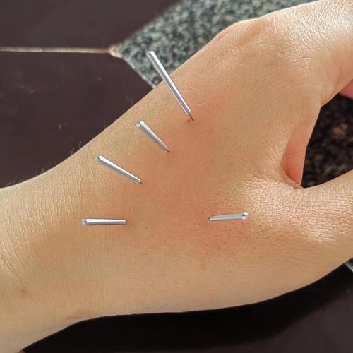 针灸治疗失眠反复吗