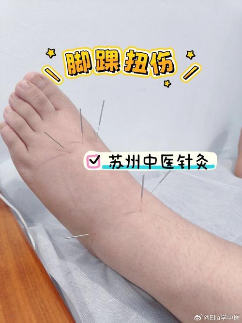 脚踝软组织肿胀针灸