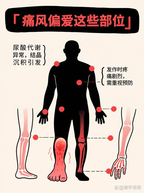 什么叫痛风有哪些症状