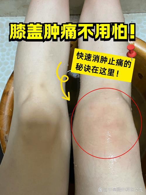 痛风膝盖肿了怎么消肿