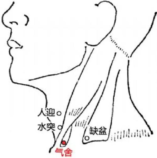 慢性咽炎针灸哪里好