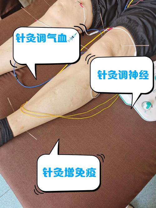 针灸治疗偏瘫的原理