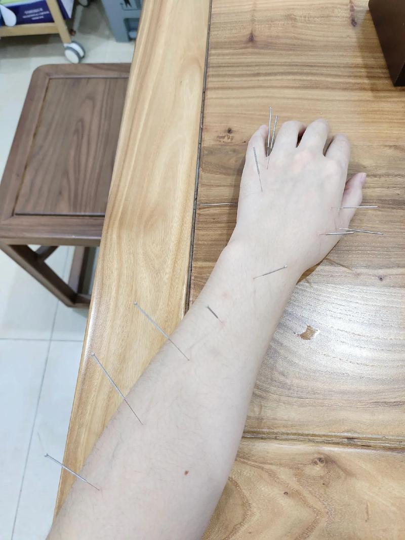 寒湿腰痛可以针灸么